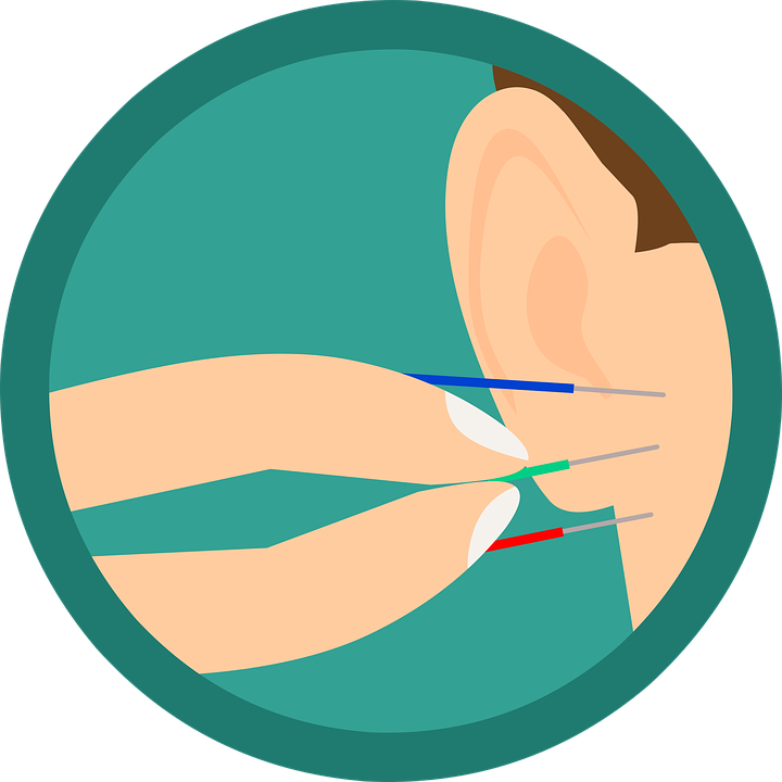 Acouphènes Acupuncture